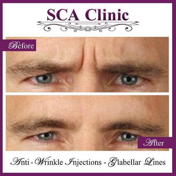 Anti-Wrinkle Injections - Glabellar Lines